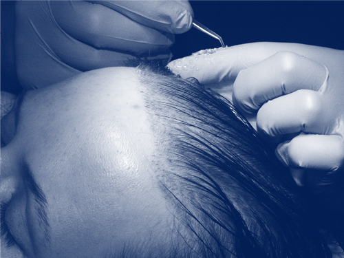La greffe de cheveux la plus fiable d'Ataşehir Fit Esthetic
