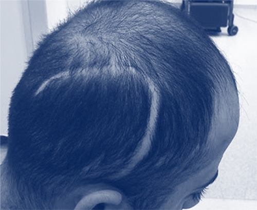 Can Hair Transplant Be Applied To The Injured Area?