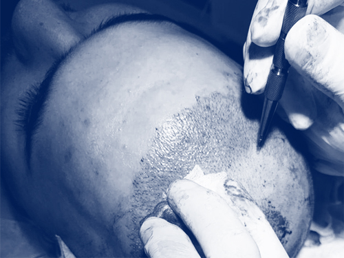 FUE technique for a fast and painless hair transplantation.