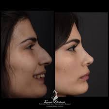 NOSE SURGERY (RHINOPLASTY)
