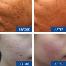 DERMAPEN DERMAPEN