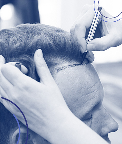 Cos'è la tecnica di trapianto di capelli IceGraft?