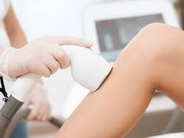 LASER EPILATION