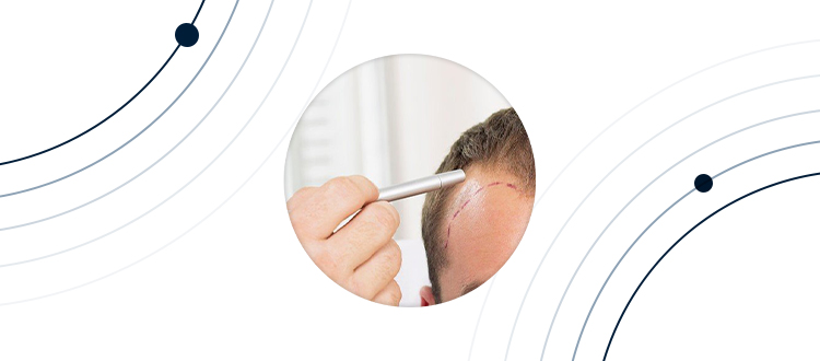 Qu'est-ce que la greffe de cheuveux? 
