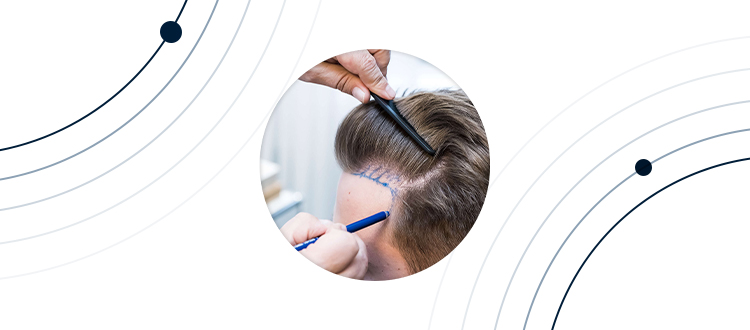 Les méthodes de la greffe de cheveux 